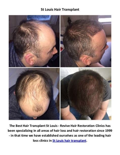 hair transplants st louis mo